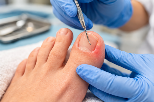 Ingrown Toenail Treatment in St. Louis