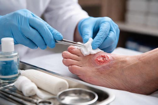 Open Wound Care in St. Louis
