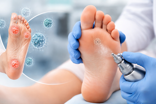 Warts Treatment in St. Louis